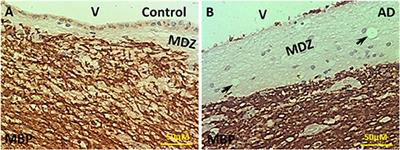 Lipopolysaccharide, Identified Using an Antibody and by PAS Staining, Is Associated With Corpora amylacea and White Matter Injury in Alzheimer's Disease and Aging Brain